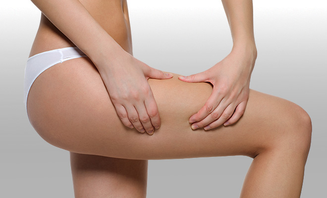 Celulitis